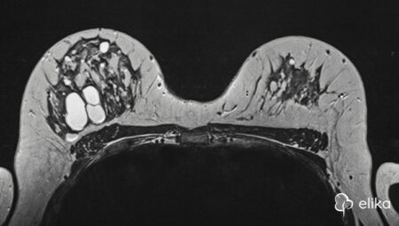 Kadınlarda Çikolata Kistleri (Endometrioma): Tanı ve Tedavi