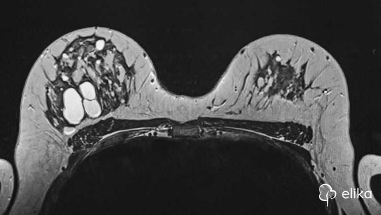 Kadınlarda Çikolata Kistleri (Endometrioma): Tanı ve Tedavi